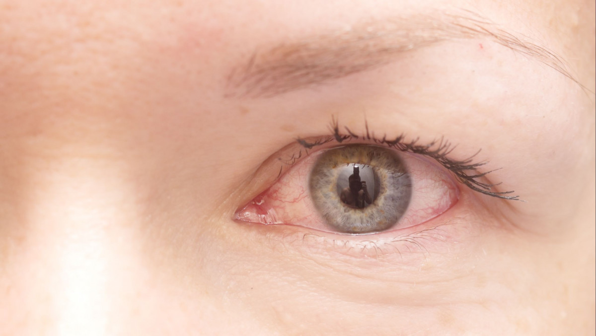 Uveitis adalah peradangan yang terjadi pada lapisan tengah mata atau uvea. 